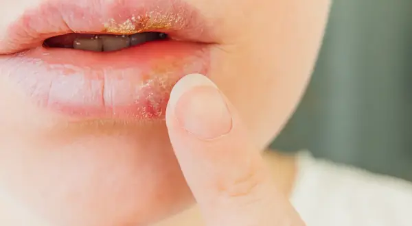Labios con herpes labial, secos y agrietados, con una costra amarillenta. Un dedo se acerca a la zona afectada.