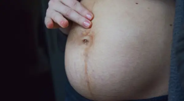 Dłoń dotyka brzucha z widoczną ciemną kreską na brzuchu w ciąży i rozstępami.