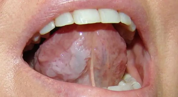 Lingua con aree bianche indicative di leucoplachia, potenziale segno precoce di tumore alla lingua.