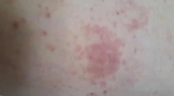 Éruption cutanée rosée sur la peau, possiblement liée à un staphylocoque doré combien de temps après opération.