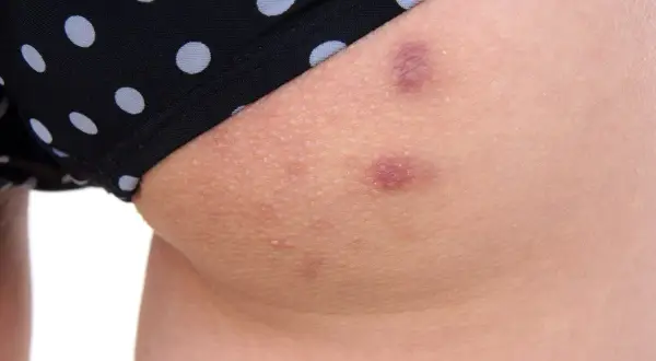 Skóra na pośladku z krostami i kilkoma zaczerwienionymi zmianami, widoczna część czarnych majtek w białe kropki.