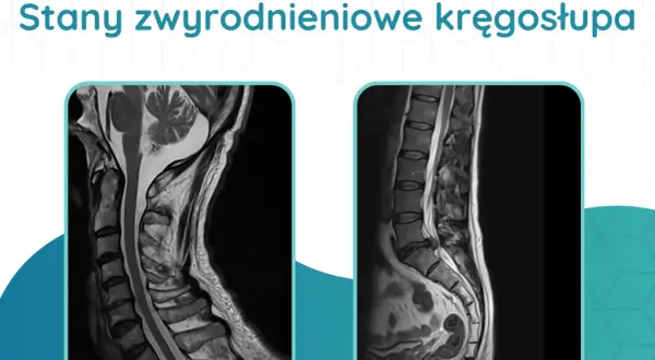 Dwa obrazy rezonansu magnetycznego kręgosłupa: szyjnego i lędźwiowego, ukazujące stany zwyrodnieniowe. Diagnostyka kręgosłupa jest kluczowa.