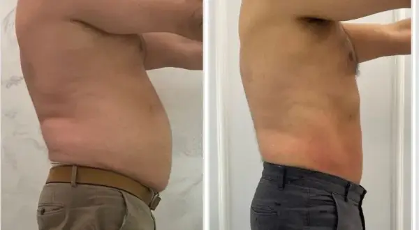 Liposukcja: Modelowanie sylwetki czy odchudzanie? Pełny przewodnik
