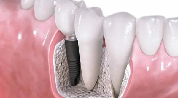Implant stomatologiczny w kości, obok naturalnego zęba. Sprawdź, jaka jest most na implantach cena.