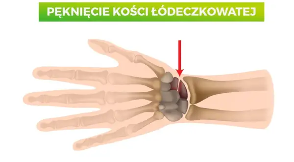 Ilustracja anatomiczna dłoni z zaznaczonym pęknięciem kości łódeczkowatej.