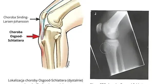 Ilustracja anatomiczna i RTG kolana pokazujące chorobę Osgooda-Schlattera, która może prowadzić do jałowej martwicy kości piszczelowej.