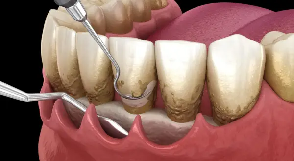 Herramientas dentales eliminan sarro en una limpieza dental profunda. El nombre del procedimiento es crucial para la salud bucal.