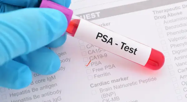 Ręka w niebieskiej rękawiczce trzyma probówkę z napisem "PSA - Test". Zaznaczono pole PSA na liście badań.