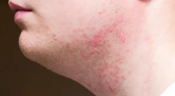 Peau irritée après rasage, avec des rougeurs et de petits boutons sur la joue.