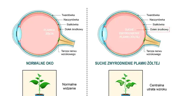 Porównanie przekroju zdrowego oka i oka z suchym zwyrodnieniem plamki żółtej.