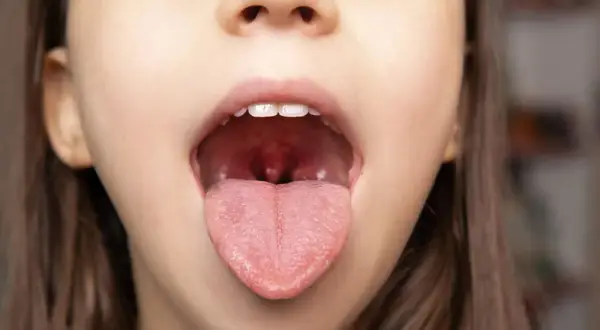 Jak uniknąć anginy? Skuteczna profilaktyka i wzmocnienie odporności