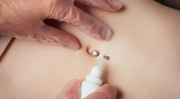 Dłoń w rękawiczce aplikuje płyn na świeży piercing pępka z błyszczącym kamieniem.
