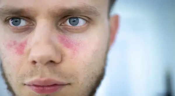 Czerwone plamy na policzkach mężczyzny, które mogą być objawem tocznia.
