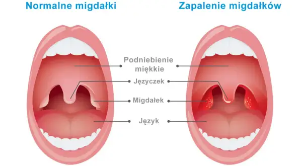 Trzeci migdał u dziecka: Obkurcz go bez operacji? Kiedy działać.