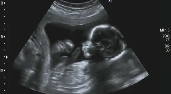 Obraz USG płodu z widoczną głową i tułowiem. Wskazuje na podejrzenie trisomii 18.
