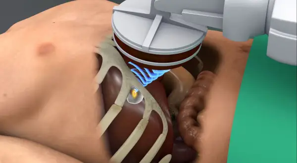 Ultraschallsonde über dem Bauchraum, ein kleiner, gelblicher tumor ultraschall erkennbar. Blaue Wellen zeigen die Schallübertragung.