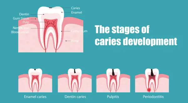 Ilustración muestra las etapas de desarrollo de una caries, desde el esmalte hasta la periodontitis, indicando cuándo empieza a doler una caries.