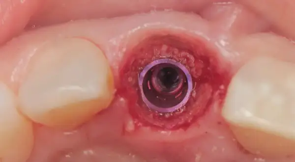Implant stomatologiczny w zębodole. Czas oczekiwania po wyrwaniu zęba na wstawienie protezy zależy od wielu czynników.