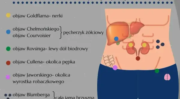 Objaw Jaworskiego wskazuje, gdzie boli wyrostek robaczkowy. Schemat pokazuje lokalizację objawów brzusznych.