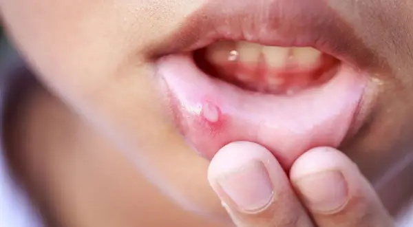 Una piccola vescicola infiammata sulla mucosa orale, vicino alle labbra, evidenziata da un dito.