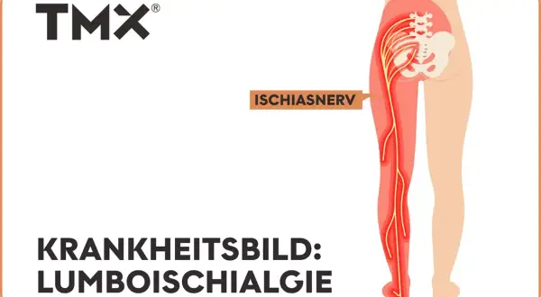 Darstellung des Ischiasnervs, der vom unteren Rücken bis zum Fuß verläuft. Das Krankheitsbild Lumboischialgie links zeigt eine Reizung dieses Nervs.