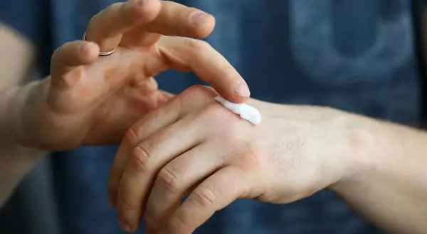Mężczyzna aplikuje krem na dłoń, być może zmagając się z problemem skóry, gdzie fusacid h może pomóc.