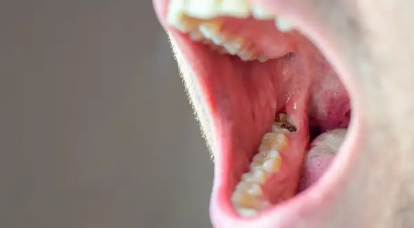 Widok otwartych ust z widocznymi zębami. Zauważalne są ubytki w zębach jedynkach, wymagające pilnej interwencji dentystycznej.