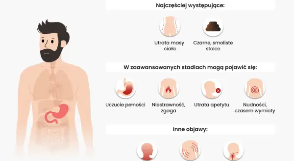 Objawy raka żołądka: utrata masy ciała, czarne stolce, uczucie pełności, niestrawność, zgaga, utrata apetytu, nudności, wymioty, osłabienie, ból pleców, trudności w połykaniu.
