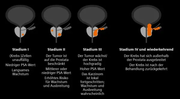 Illustrationen zeigen Stadien von Prostatakrebs, von Stadium I (unauffällig) bis Stadium IV (ausgebreitet), die die Entwicklung eines Adenokarzinoms der Prostata veranschaulichen.