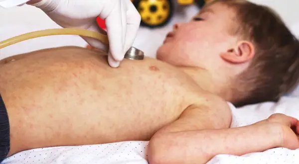 Läkare undersöker ett barn med utslag, möjligen biverkningar efter 5 månaders vaccin.