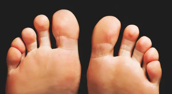 Piedi con alluce valgo, un problema comune per cui esistono diversi rimedi.