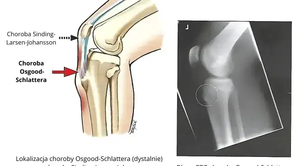 Ilustracja anatomiczna i RTG kolana pokazują lokalizację choroby Osgood-Schlattera. Unikaj nadmiernego obciążenia tej okolicy.
