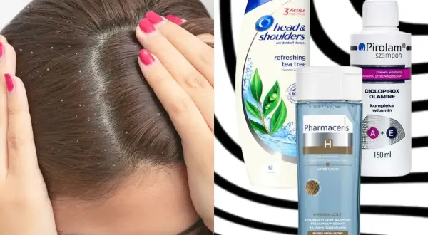 Łupież na głowie i szampony przeciwłupieżowe: Head & Shoulders, Pirolam, Pharmaceris. Co jest dobre na łupież?