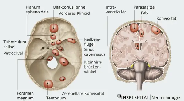 Anatomische Darstellung des Schädels mit roten Markierungen, die auf mögliche gutartige Tumoren im Kopf hindeuten. Symptome können je nach Lage variieren.