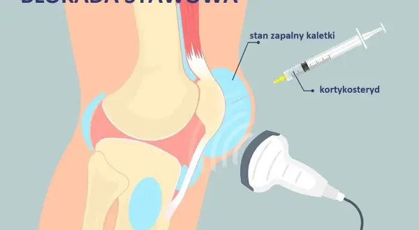 Zastrzyk z kortykosteroidu w stan zapalny kaletki stawu kolanowego, widoczne ścięgna w kolanie.