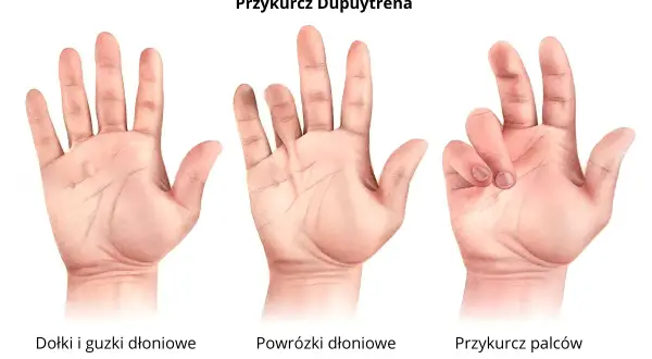 Trzy dłonie pokazujące postęp przykurczu Dupuytrena: zdrowe, z powrózkami i z przykurczem palców.