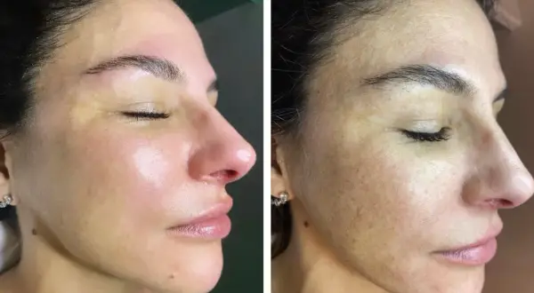 Viso prima e dopo acido mandelico: pelle più luminosa e uniforme, macchie attenuate.