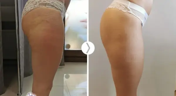 Endermologia: Co ile zabiegów? Twój plan na trwałe efekty!