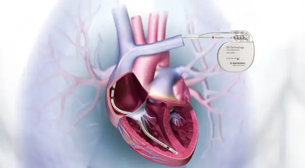 Cœur humain avec un défibrillateur cardiaque implanté, relié à un appareil externe.