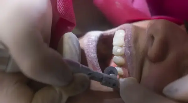 Dentysta wygładza ostry brzeg kości po usunięciu zęba, używając małego wiertła.