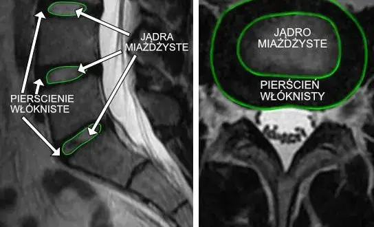 Zapalenie krążka międzykręgowego objawy: jak je rozpoznać i leczyć