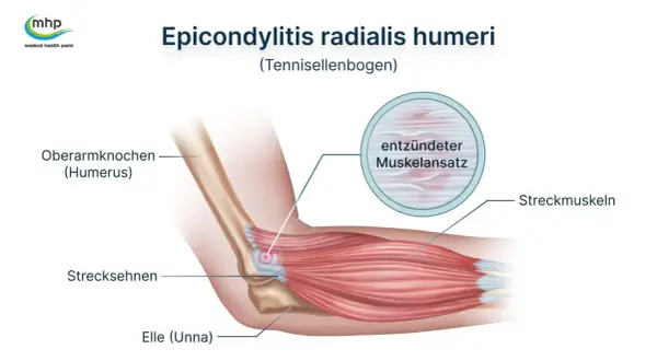 Illustration zeigt den Tennisellenbogen (Epicondylitis radialis humeri) mit entzündetem Muskelansatz. Darf man mit Tennisarm arbeiten? Ja, oft mit Anpassungen.
