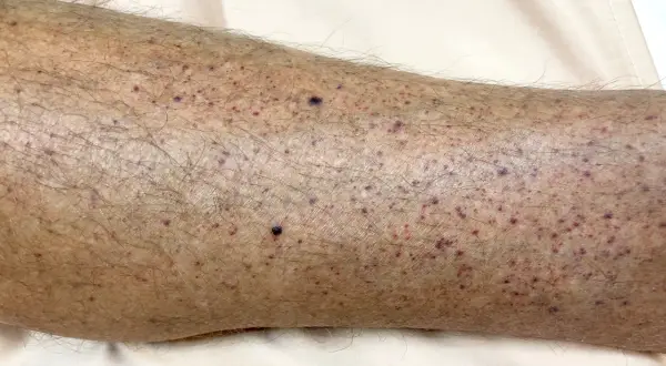 Hud med många små lila prickar, som kan vara symtom på leukemi hos barn.