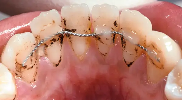 Denti con placca e filo metallico per contenzione denti.