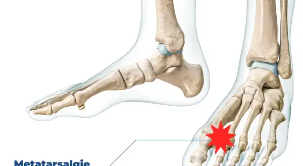 Metatarsalgie: Schmerzen im Vorfuß bei jedem Schritt. Anatomische Darstellung des Fußskeletts mit Hervorhebung des schmerzenden Bereichs.