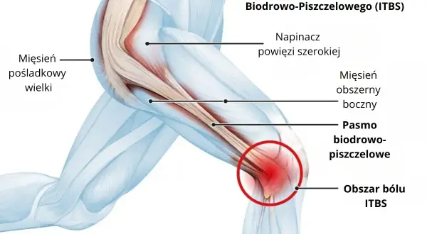 Anatomia bólu kolana przy zespole pasma biodrowo piszczelowego. Czerwony obszar bólu ITBS zaznaczony na kolanie.