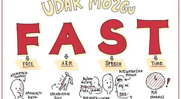 Udar mózgu u dzieci: FAST - twarz, ręka, mowa, czas. Objawy: opadnięty kącik ust, osłabienie siły mięśniowej, nieadekwatne słowa, braki w mowie, brak reakcji na czas.