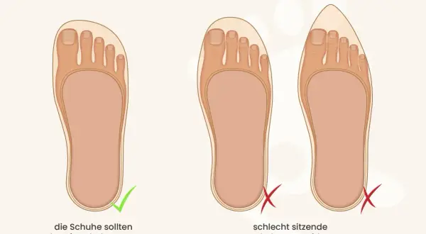 Passende Schuhe sind wichtig, um Druckstellen am Zeh zu vermeiden. Links ein Fuß im gut sitzenden Schuh, rechts Füße in zu engen Schuhen.