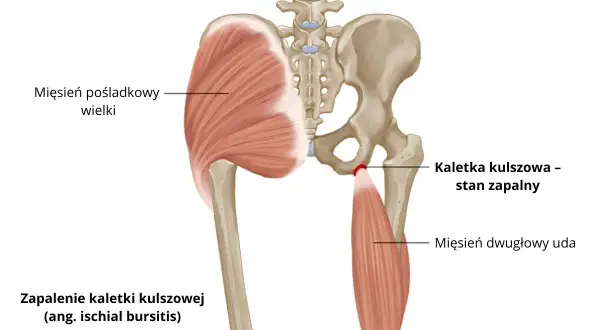 Anatomia miednicy z zaznaczonym zapaleniem kaletki kulszowej. Widoczny mięsień pośladkowy wielki i dwugłowy uda.