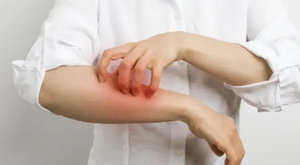 Une personne se gratte le bras, la peau rougie et irritée, possiblement à cause d'une allergie au calcaire.